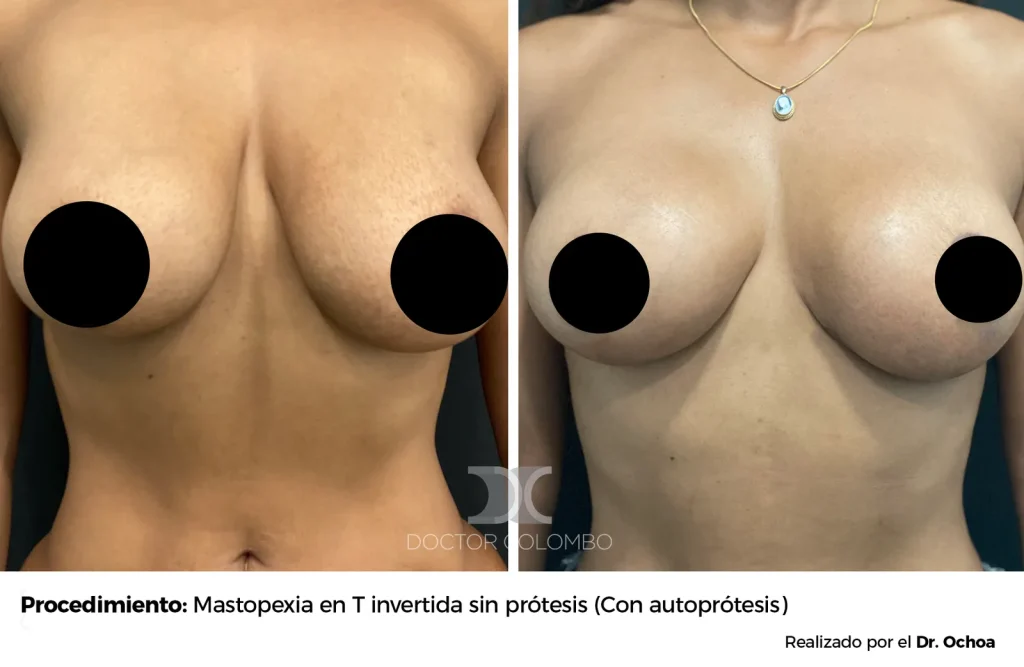 MASTOPEXIA EN T INVERTIDA SIN  PROTESIS – SIN NOCHE DE HOSPITALIZACIÓN — 6052 — Frontal