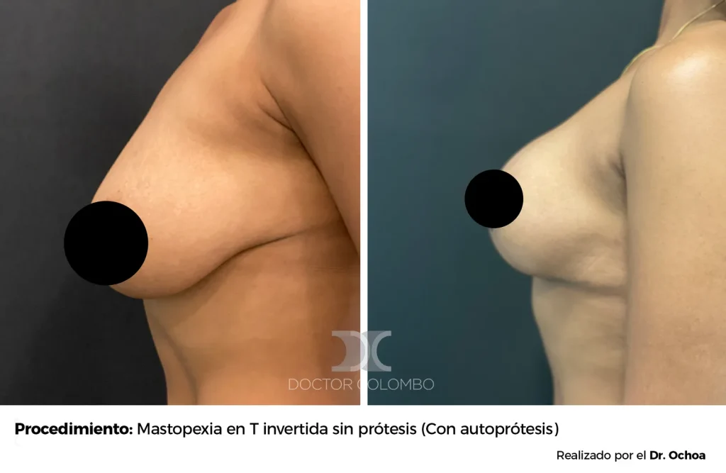 MASTOPEXIA EN T INVERTIDA SIN  PROTESIS – SIN NOCHE DE HOSPITALIZACIÓN — 6052 — Perfil izquierdo