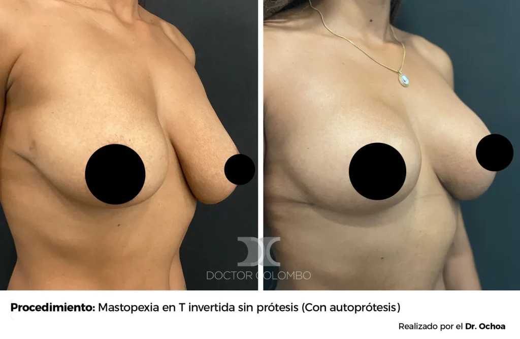 MASTOPEXIA EN T INVERTIDA SIN  PROTESIS – SIN NOCHE DE HOSPITALIZACIÓN — 6052 — Perfil derecho