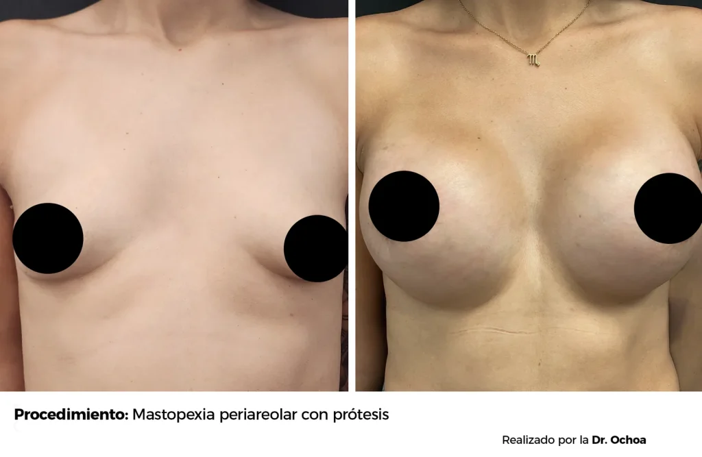MASTOPEXIA PERIAREOLAR CON PROTESIS — 6921 — Frontal