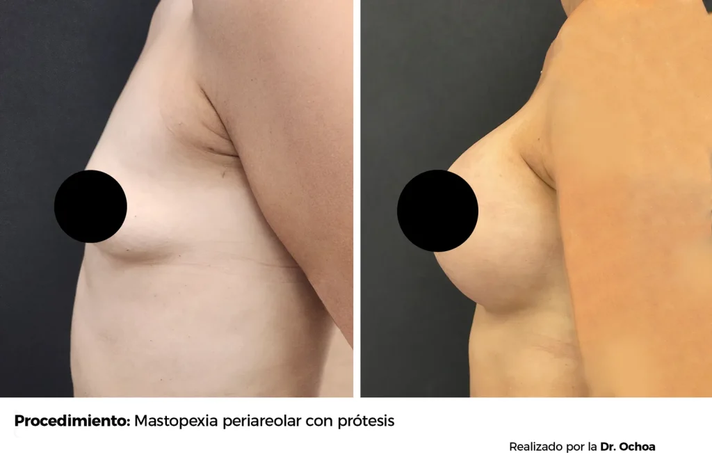 MASTOPEXIA PERIAREOLAR CON PROTESIS — 6921 — Perfil izquierdo
