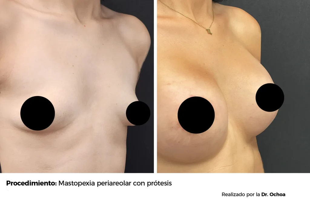 MASTOPEXIA PERIAREOLAR CON PROTESIS — 6921 — Perfil derecho