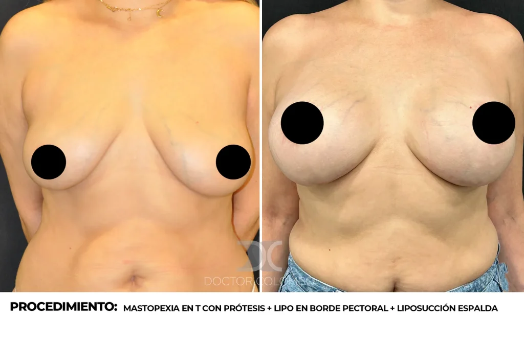 MASTOPEXIA EN T CON PRÓTESIS + LIPO EN BORDE PECTORAL + LIPOSUCCIÓN ESPALDA ALTA Y MEDIA — 702 — Perfil derecho