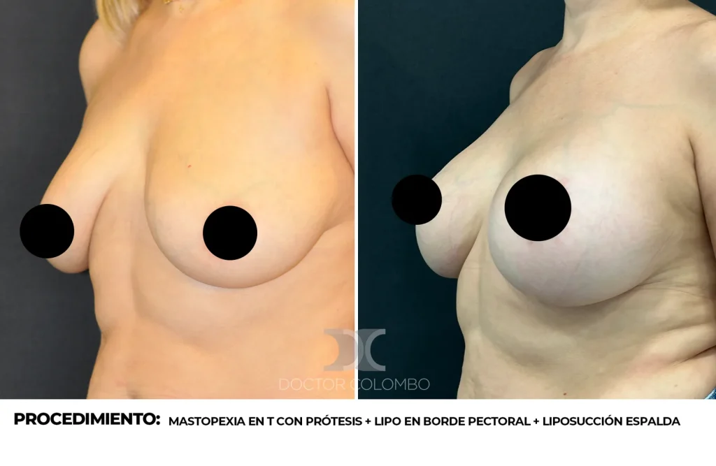 MASTOPEXIA EN T CON PRÓTESIS + LIPO EN BORDE PECTORAL + LIPOSUCCIÓN ESPALDA ALTA Y MEDIA — 702 — Perfil izquierdo