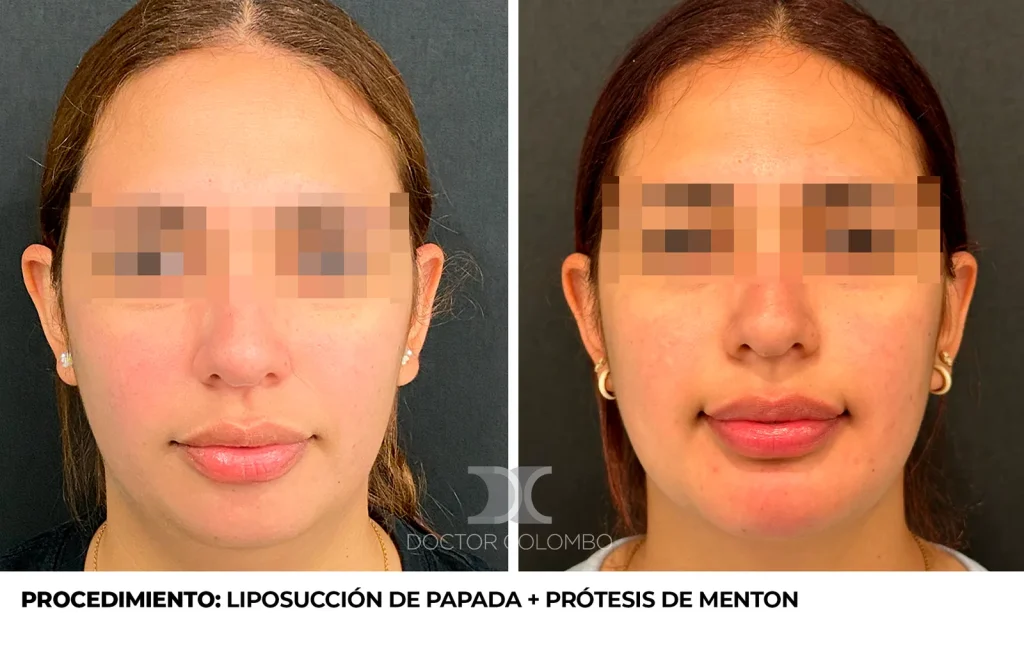 LIPO DE PAPADA Y PROTESIS DE MENTON — Perfil derecho