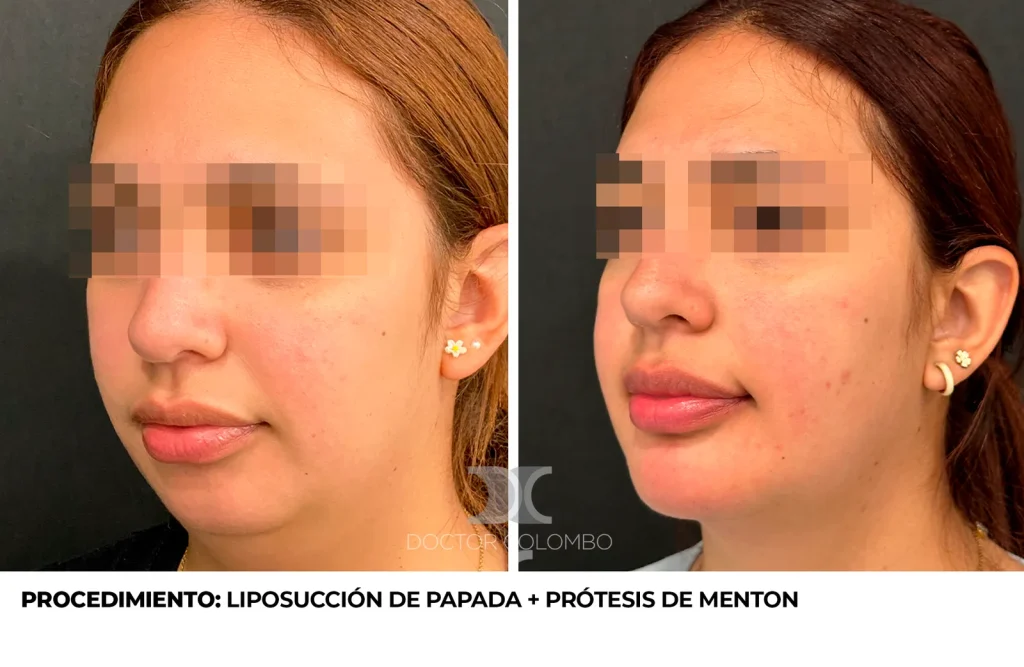 LIPO DE PAPADA Y PROTESIS DE MENTON — Perfil izquierdo