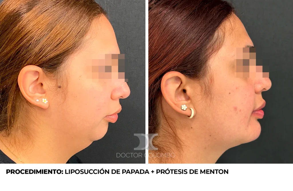 LIPO DE PAPADA Y PROTESIS DE MENTON — Frontal