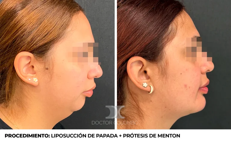 Antes y después de Prótesis de mentón