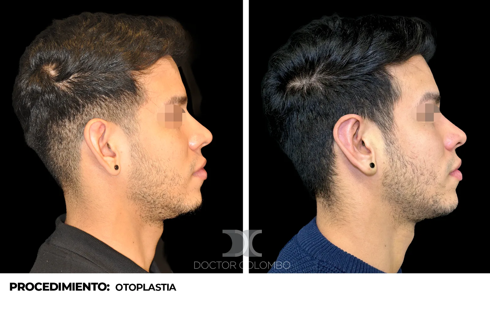 Resultado de otoplastia - antes y después, vista posterior