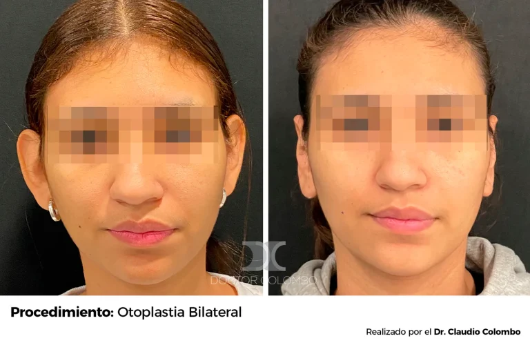 Antes y después de Otoplastia