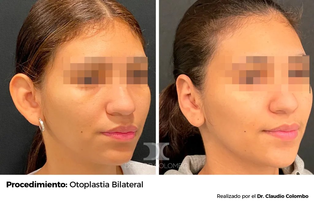 OTOPLASTIA CON RESECCIÓN DE CONCHA AURICULAR  – CON ANESTESIA LOCAL – AMBULATORIO — 5575 — Perfil derecho
