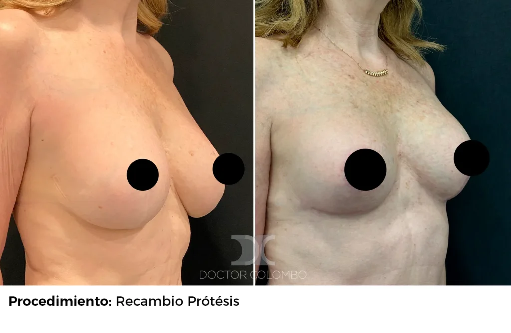 MASTOPEXIA EN T INVERTIDA + RECAMBIO DE PROTESIS + LIPOSUCCIÓN VASER® DE BORDE DE PECTORAL + REDUCCION DE PEZONES – SIN NOCHE DE HOSPITALIZACIÓN — 2641 — Perfil derecho
