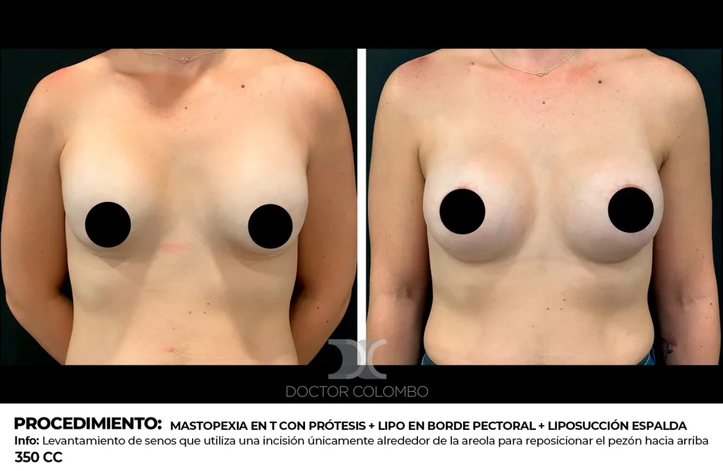 MASTOPEXIA PERIAREOLAR CON RECAMBIO DE PROTESIS – SIN NOCHE DE HOSPITALIZACIÓN — 2810 — Vista 1