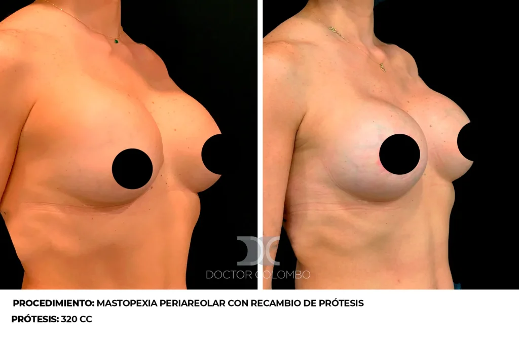 RECAMBIO PROTESIS POR VIA PERIAREOLAR  – SIN NOCHE DE HOSPITALIZACIÓN – ES COLABORACIÓN — 3713 — Perfil derecho
