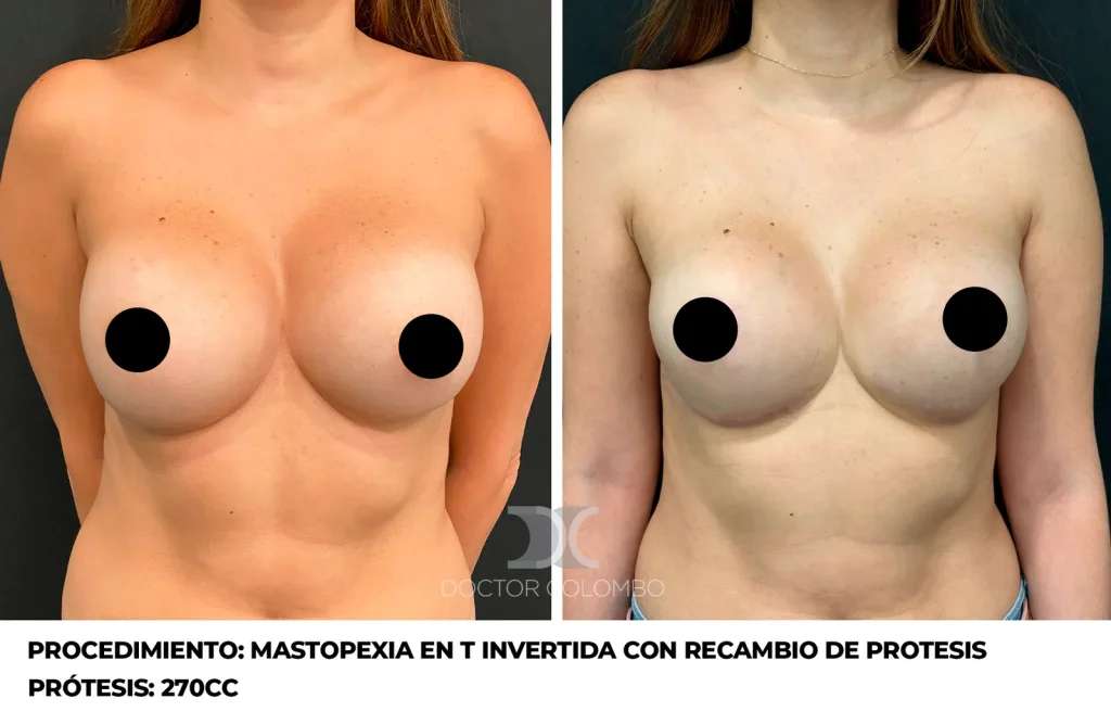 MASTOPEXIA EN T INVERTIDA CON RECAMBIO DE PROTESIS — 5013 — Frontal
