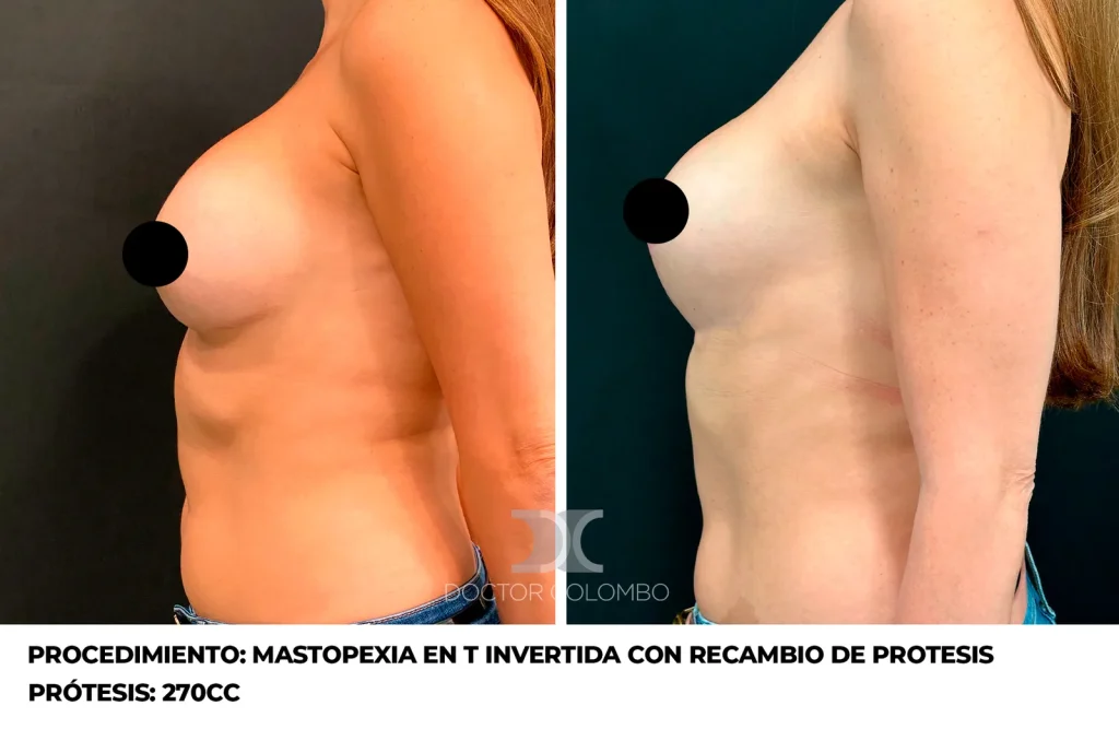 MASTOPEXIA EN T INVERTIDA CON RECAMBIO DE PROTESIS — 5013 — Perfil izquierdo