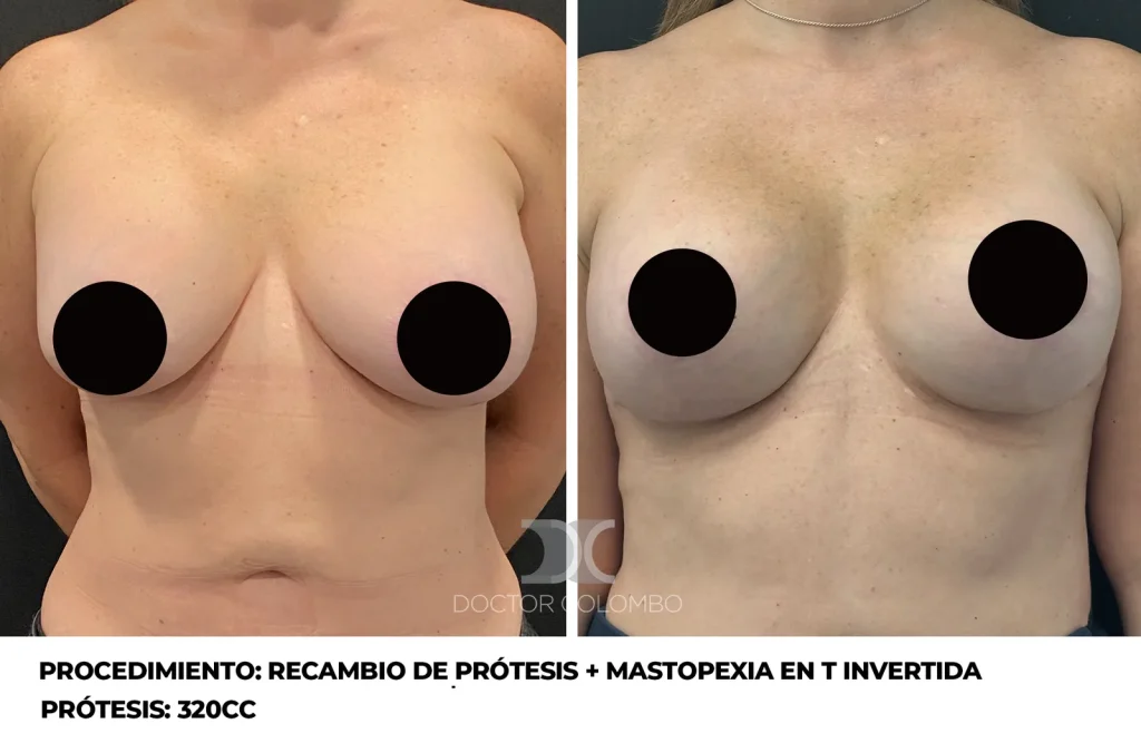 RECAMBIO DE PROTESIS + CAPSULECTOMIA DERECHA + REFACCIÓN DE BOLSILLO + MASTOPEXIA EN T INVERTIDA – SIN NOCHE DE HOSPITALIZACIÓN — 665 — Frontal