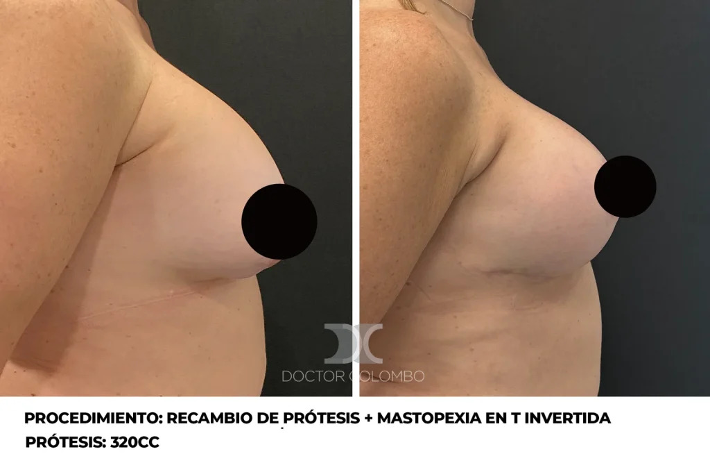 RECAMBIO DE PROTESIS + CAPSULECTOMIA DERECHA + REFACCIÓN DE BOLSILLO + MASTOPEXIA EN T INVERTIDA – SIN NOCHE DE HOSPITALIZACIÓN — 665 — Perfil derecho