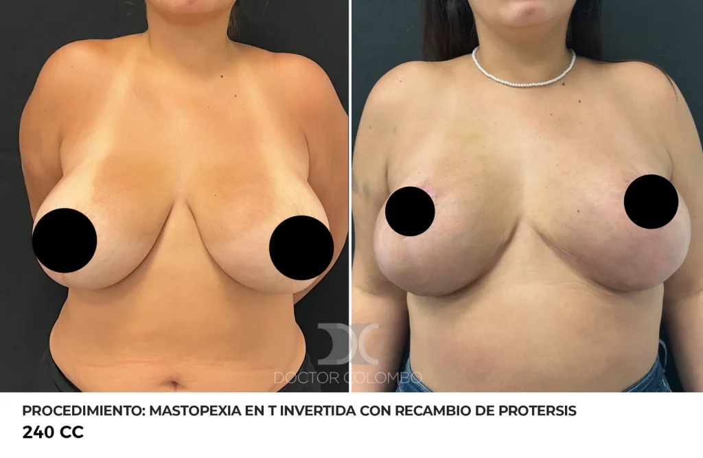 MASTOPEXIA EN T INVERTIDA CON RECAMBIO DE PROTERSIS + LIPOSUCCIÓN DE COLA DE MAMA Y BORDE DE PECTORAL + REFACCIÓN DE BOLISLLO – SIN NOCHE DE HOSPITALIZACIÓN — 6923 — Frontal