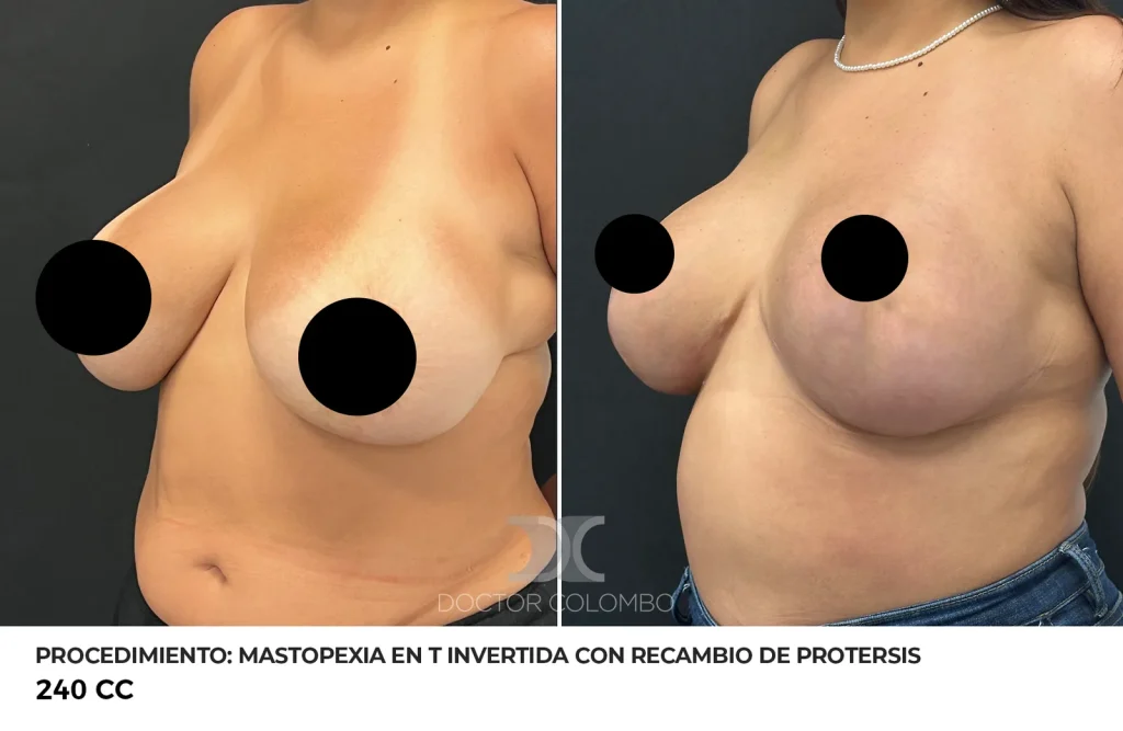 MASTOPEXIA EN T INVERTIDA CON RECAMBIO DE PROTERSIS + LIPOSUCCIÓN DE COLA DE MAMA Y BORDE DE PECTORAL + REFACCIÓN DE BOLISLLO – SIN NOCHE DE HOSPITALIZACIÓN — 6923 — Perfil izquierdo