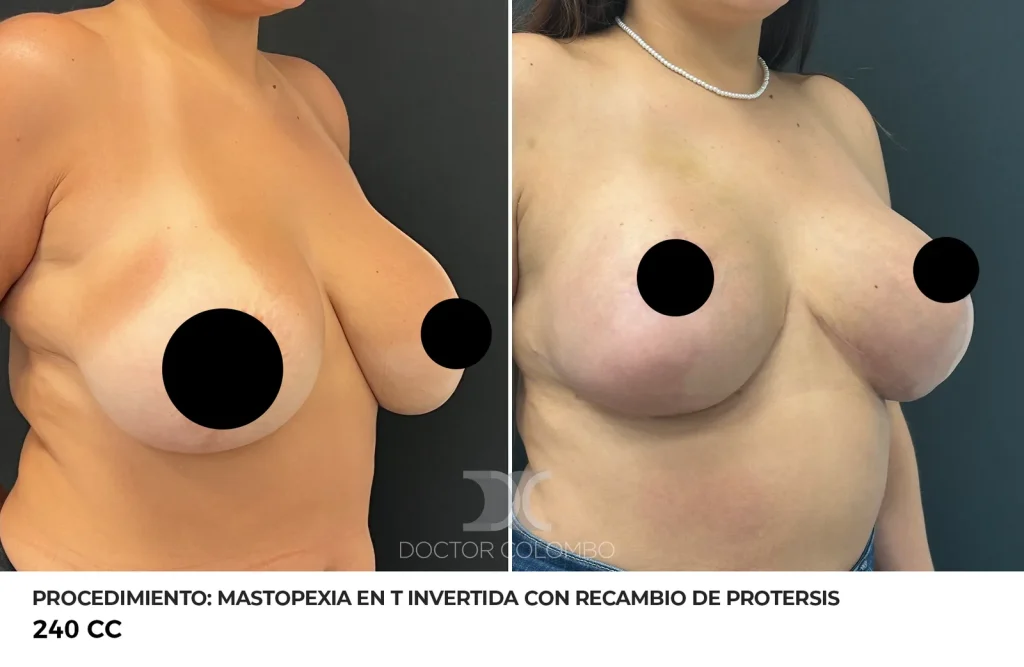 MASTOPEXIA EN T INVERTIDA CON RECAMBIO DE PROTERSIS + LIPOSUCCIÓN DE COLA DE MAMA Y BORDE DE PECTORAL + REFACCIÓN DE BOLISLLO – SIN NOCHE DE HOSPITALIZACIÓN — 6923 — Perfil derecho