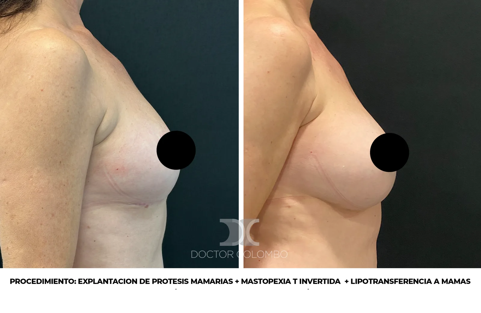 Resultado de lipotransferencia mamaria - Dr. Colombo