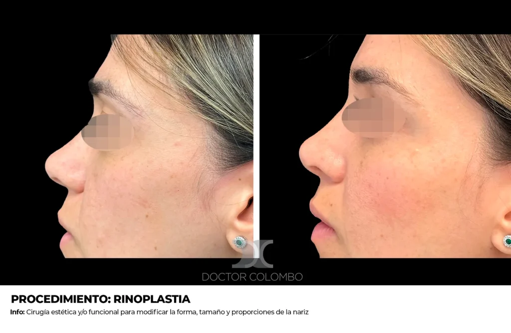 RINOPLASTIAS — 2396 — Vista 1