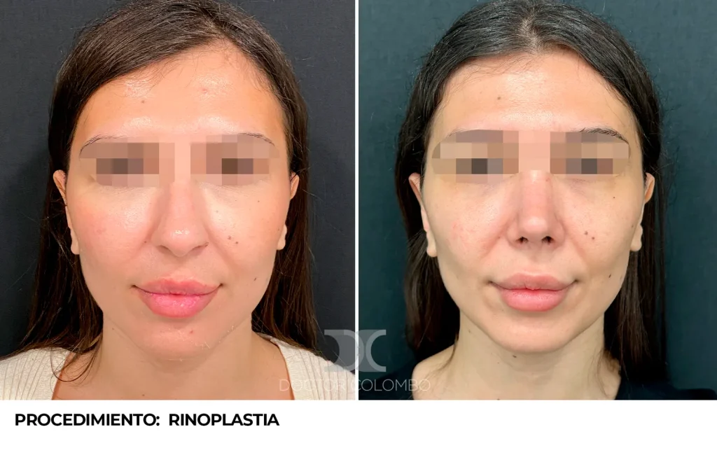 RINOPLASTIA ESTÉTICA ULTRASÓNICA — 3447 — Perfil derecho