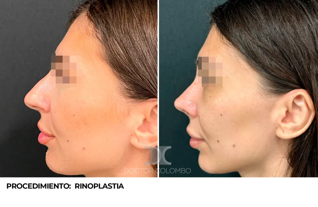RINOPLASTIA ESTÉTICA ULTRASÓNICA — 3447 — Perfil izquierdo