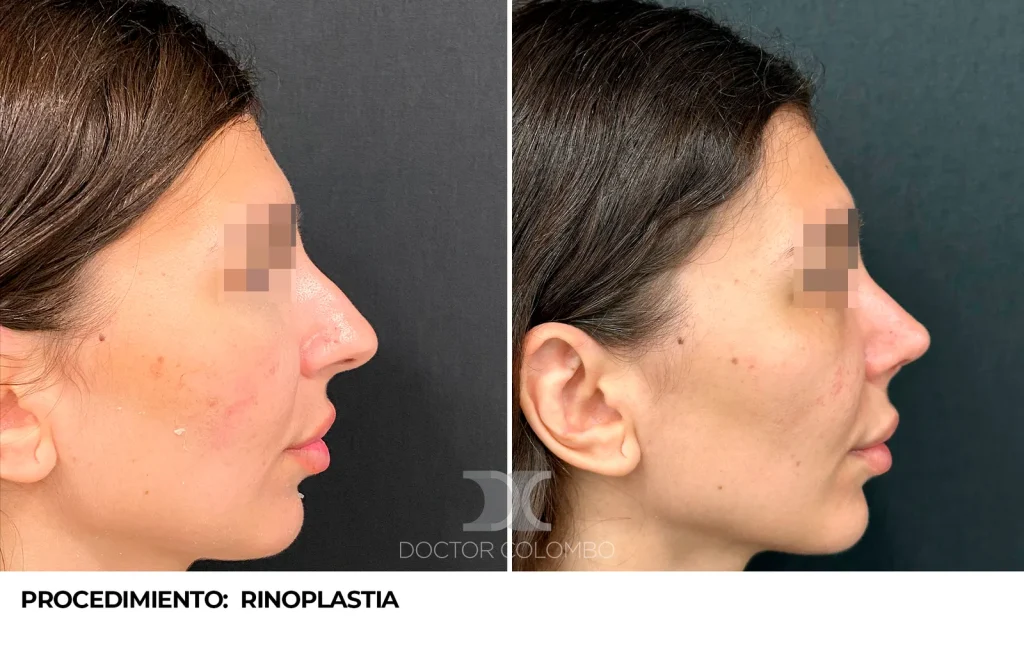 RINOPLASTIA ESTÉTICA ULTRASÓNICA — 3447 — Frontal