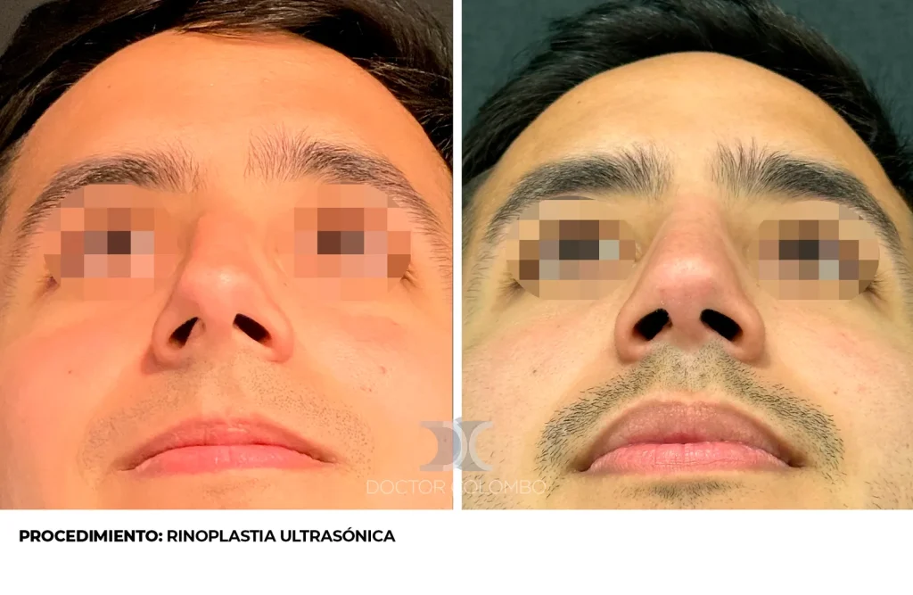 RINOSEPTOPLASTIA ULTRASÓNICA — 3539 — Perfil derecho