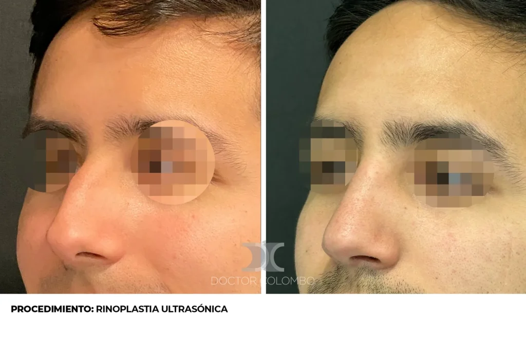 RINOSEPTOPLASTIA ULTRASÓNICA — 3539 — Perfil izquierdo