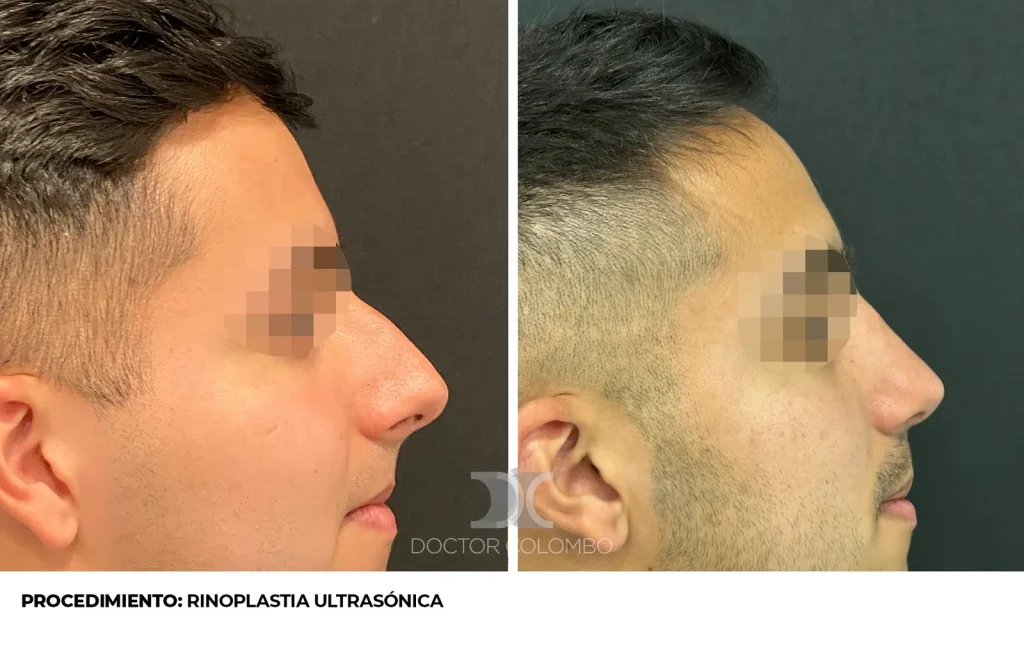 RINOSEPTOPLASTIA ULTRASÓNICA — 3539 — Frontal