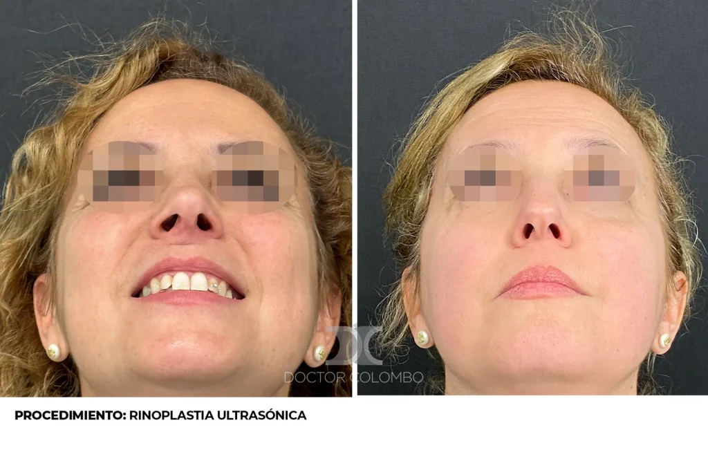 RINOSEPTOPLASTIA ULTRASÓNICA — 3813 — Perfil derecho