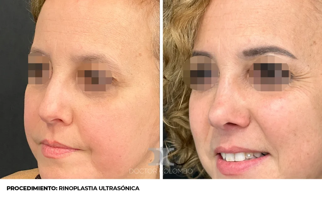 RINOSEPTOPLASTIA ULTRASÓNICA — 3813 — Perfil izquierdo