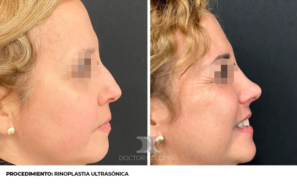 RINOSEPTOPLASTIA ULTRASÓNICA — 3813 — Frontal