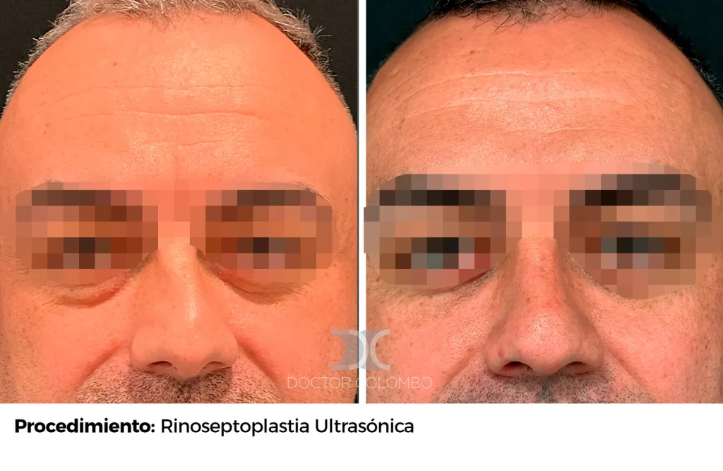 RINOSEPTOPLASTIA ULTRASÓNICA + BLEFAROPLASTIA INFERIOR TRANSCONJUNTIVAL + MICRO Y NANOFAT GRAFTING A PARPADO INFERIOR — 5460 — Frontal