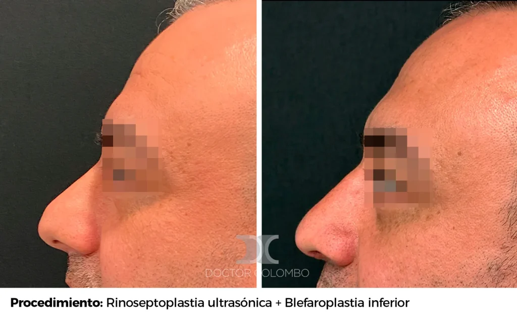 RINOSEPTOPLASTIA ULTRASÓNICA + BLEFAROPLASTIA INFERIOR TRANSCONJUNTIVAL + MICRO Y NANOFAT GRAFTING A PARPADO INFERIOR — 5460 — Perfil izquierdo