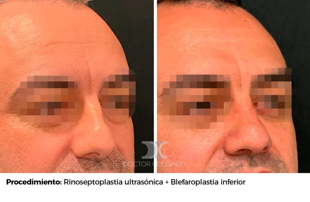 RINOSEPTOPLASTIA ULTRASÓNICA + BLEFAROPLASTIA INFERIOR TRANSCONJUNTIVAL + MICRO Y NANOFAT GRAFTING A PARPADO INFERIOR — 5460 — Perfil derecho
