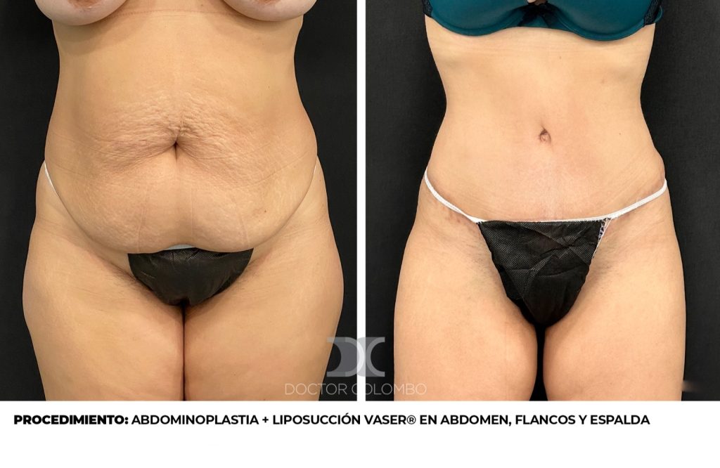 ABDOMINOPLASTIA + LIPOSUCCIÓN VASER® EN ABDOMEN, FLANCOS Y ESPALDA — Vista 1