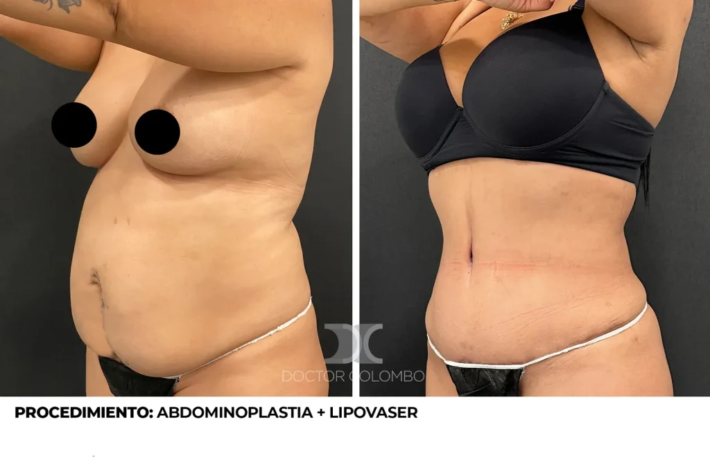ABDOMINOPLASTIA + LIPOSUCCIÓN VASER® DE ABDOMEN, FLANCOS, ESPALDA + LIPOTRANSFERENCIA A GLÚTEOS — Perfil izquierdo
