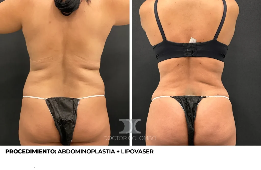 ABDOMINOPLASTIA + LIPOSUCCIÓN VASER® DE ABDOMEN, FLANCOS, ESPALDA + LIPOTRANSFERENCIA A GLÚTEOS — Frontal