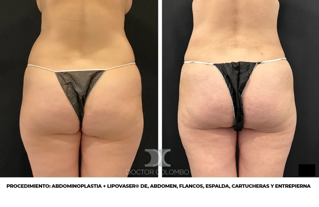 ABDOMINOPLASTIA + LIPOSUCCIÓN VASER® DE PAPADA, BRAZOS, ABDOMEN, FLANCOS, ESPALDA, CARTUCHERAS Y ENTREPIERNA – CON NOCHE DE HOSPITALIZACIÓN — Vista 1