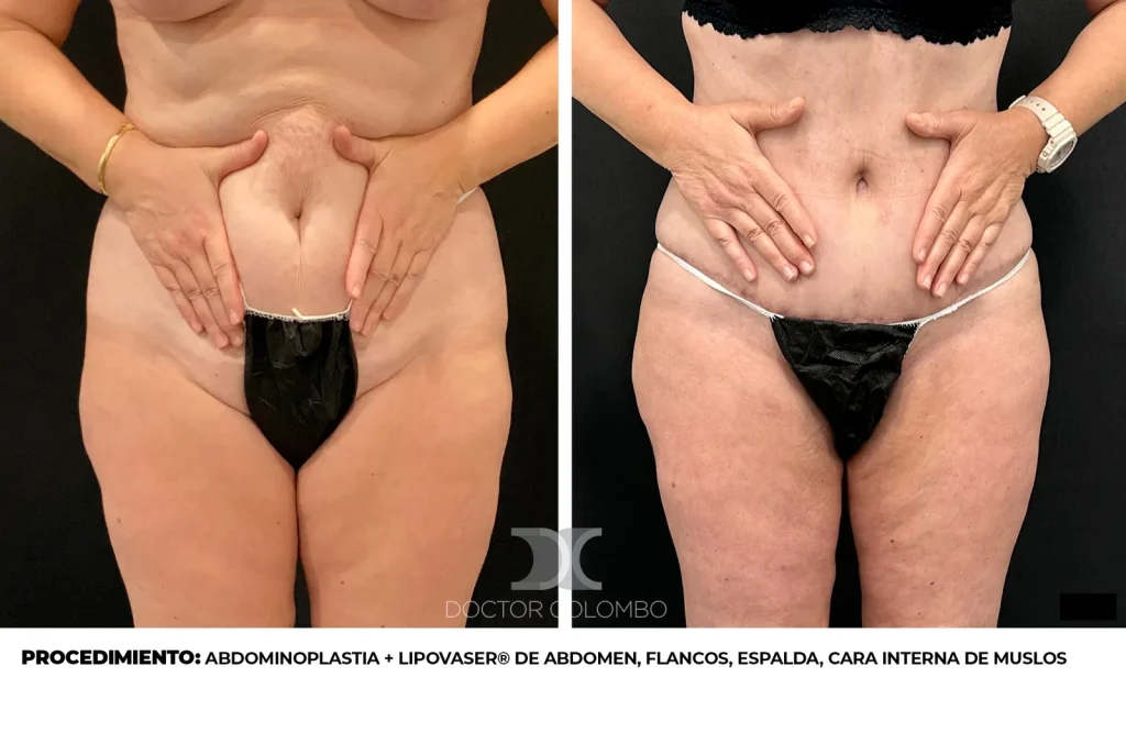 ABDOMINOPLASTIA + LIPOSUCCIÓN VASER® DE ABDOMEN, FLANCOS, ESPALDA, CARA INTERNA DE MUSLOS Y RODILLAS + SUPRAROTULIANO – CON NOCHE DE HOSPITALIZACIÓN — Vista 1