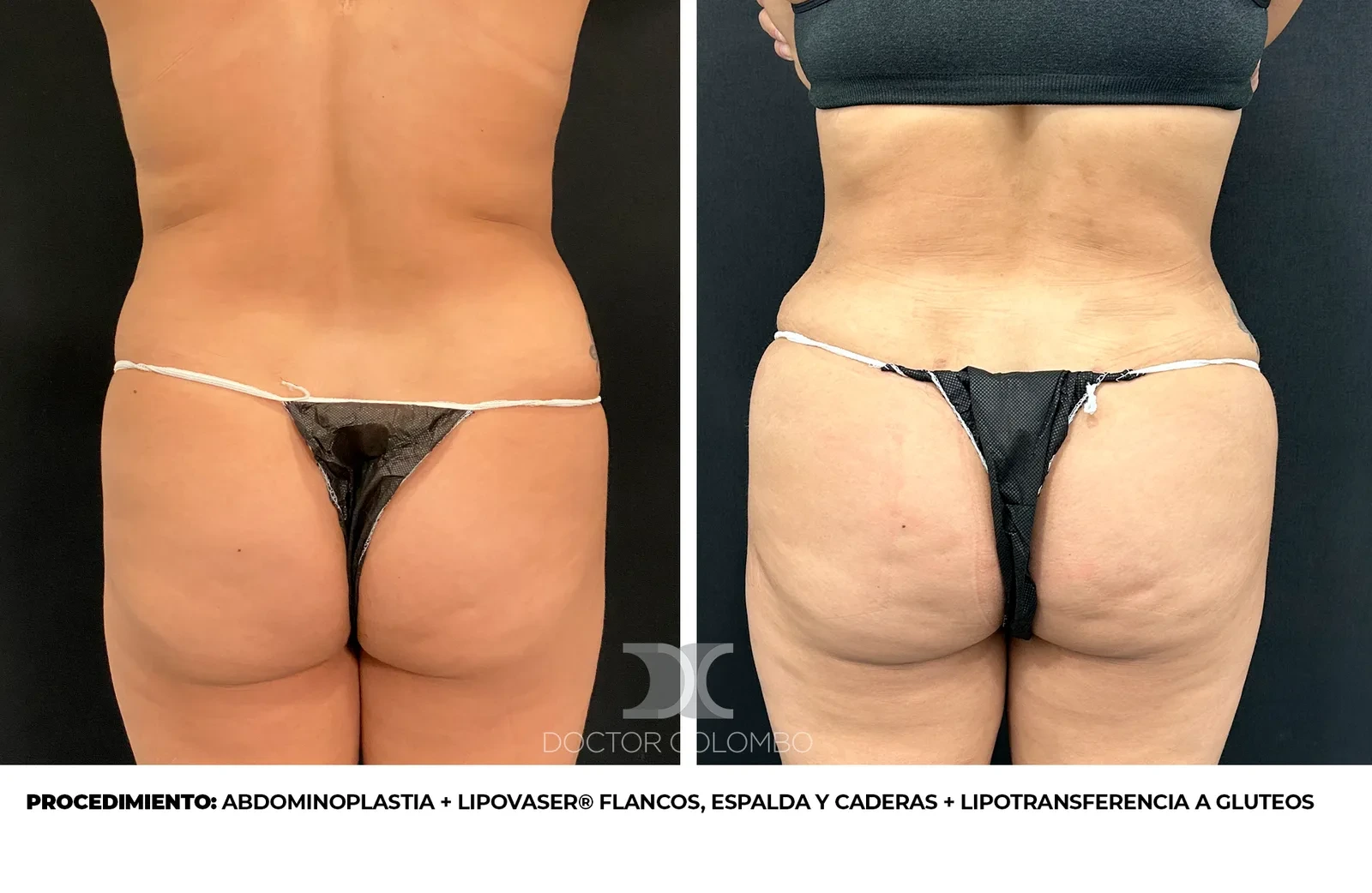Antes y después lipotransferencia glúteos BBL - Dr. Colombo Madrid