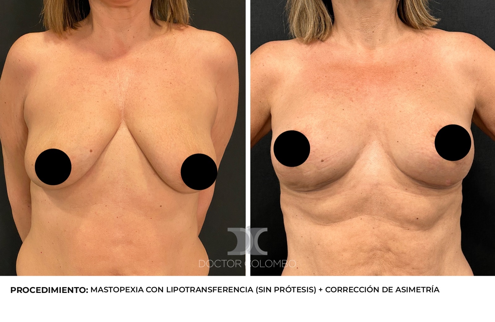 Antes y después corrección de asimetría mamaria - Dr. Colombo, vista frontal