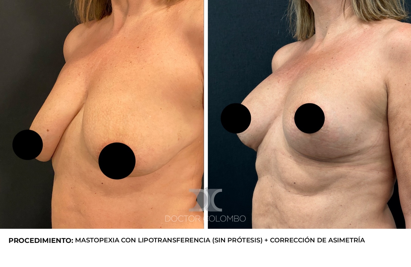 Antes y después corrección de asimetría mamaria - Dr. Colombo, vista de perfil