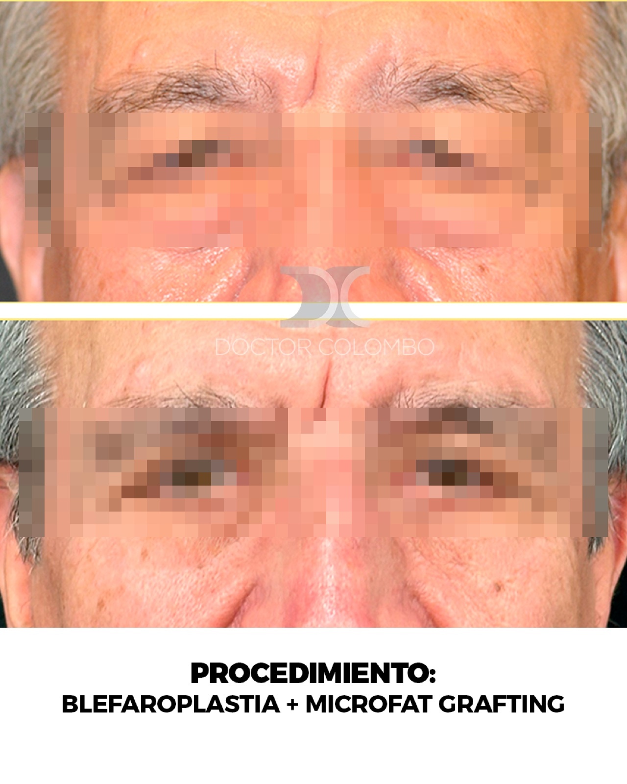 Blefaroplastia - antes y después, vista frontal