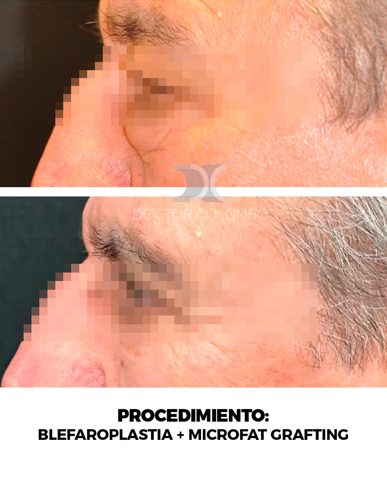 Blefaroplastia - antes y después, vista de perfil