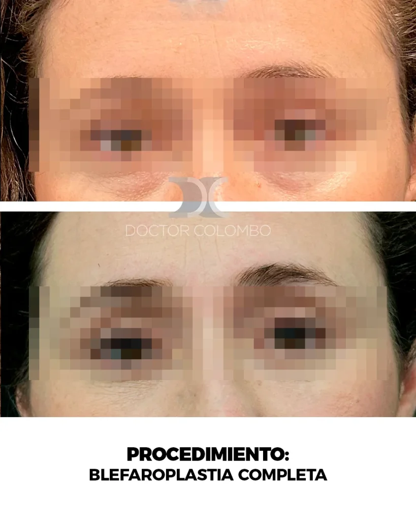 BLEFAROPLASTIA COMPLETA TRANSCONJUNTIVAL + RESECCIÓN DE BOLSAS. MICROFAT GRAFTING EN OJERAS Y NANOFAT EN PIEL. — Frontal